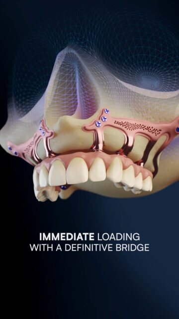 A New Approach to Severe Bone Atrophy

Severe bone atrophy remains one of the most challenging situations in implantology.

This video illustrates an alternative approach based on digital subperiosteal implants.
A concept designed to overcome the limitations of conventional grafting procedures.

By combining CBCT imaging, CAD design, and patient-specific manufacturing, it becomes possible to rethink anchorage, biomechanics, and treatment timelines.

The use of pterygoid anchorage, a fully digital workflow, and immediate loading protocols allows treatment in a single surgical stage, with a definitive prosthesis delivered on the same day.

More than a technique, it reflects the evolution of implantology toward precision and engineering-driven solutions.

#implantology #dentalimplants #subperiostealimplant #digitaldentistry #cadcamdentistry #cbct #oralimplantology #fullarch #severeatropy #pterygoidimplants #immediateloading #dentaleducation #dentalsurgery #biomechanics #prosthodontics #oralrehabilitation #3ddentistry #customimplants #titaniumimplants #dentistlife