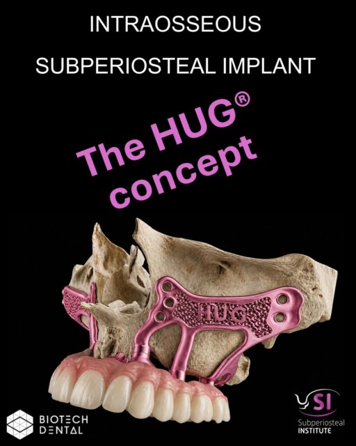 ✨ Intraosseous Subperiosteal Implant Concept
As tissue recession is the most common complication in subperiosteal implants, the formation of new bone above the implant arm helps support the gingiva and reduce the risk of recession.
This can be achieved through several key features:
– gyroid lattice structure
– bone reduction guide
– biomaterial coverage with a collagen membrane
🎯 Want to learn more?
👉 Free webinar – Tuesday, May 12 at 8 PM (Paris time)
👉 Hands-on course in Nice, France – Saturday, June 13 (full day)
🔥 Links in the Subperiosteal Institute’s profile
#implantdentistry #dentalimplants #oralimplantology
#subperiostealimplant #digitaldentistry