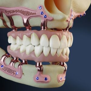 SUBPERIOSTEAL IMPLANTS TRAINING – June 13, 2026 – NICE